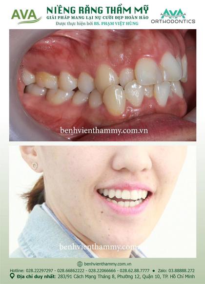 Ca niềng răng trả góp tphcm trước và sau điều trị tại Nha khoa AVA, ca 68