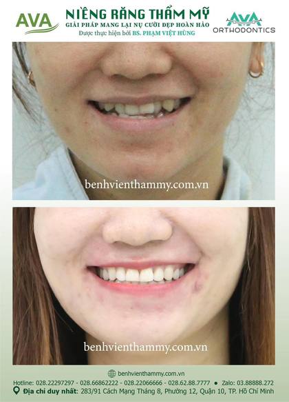 Kết quả niềng răng TPHCM trước và sau tại Nha khoa AVA Quận 10, ca 70