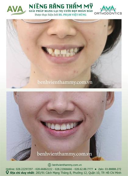 Hình ảnh trước và sau khi niềng răng – niềng răng trả góp quận 10 tại Nha khoa AVA, ca 72