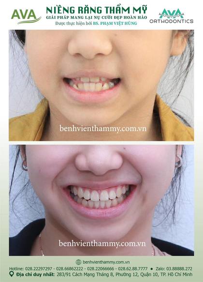 Kết quả niềng răng TPHCM trước và sau tại Nha khoa AVA Quận 10, ca 73