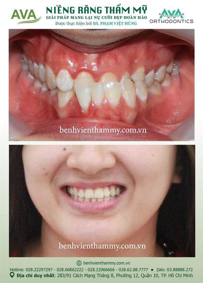 Ca niềng răng trả góp tphcm trước và sau điều trị tại Nha khoa AVA, ca 04
