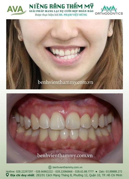 Hình ảnh trước và sau khi niềng răng – niềng răng trả góp quận 10 tại Nha khoa AVA, ca 75