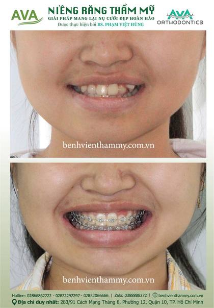 Ca niềng răng trả góp tphcm trước và sau điều trị tại Nha khoa AVA, ca 77