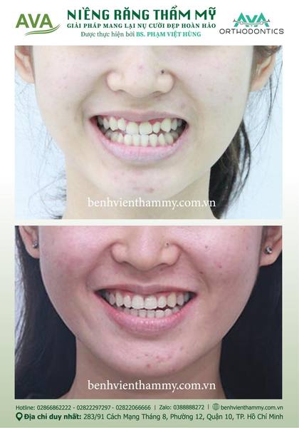 Hình ảnh trước và sau khi niềng răng – niềng răng trả góp quận 10 tại Nha khoa AVA, ca 78