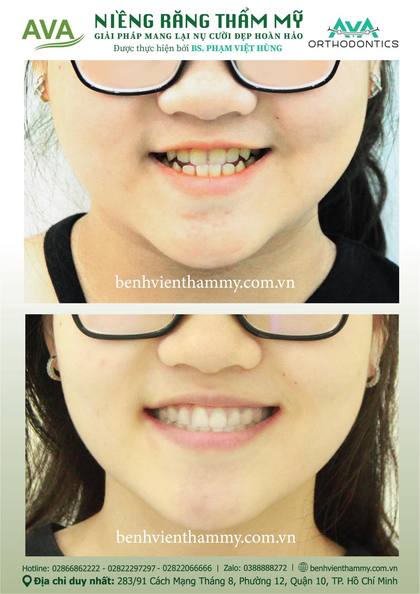 Kết quả niềng răng TPHCM trước và sau tại Nha khoa AVA Quận 10, ca 79
