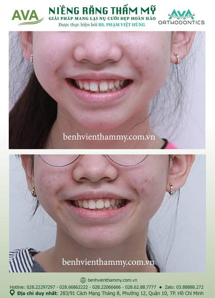 Ca niềng răng trả góp tphcm trước và sau điều trị tại Nha khoa AVA, ca 80