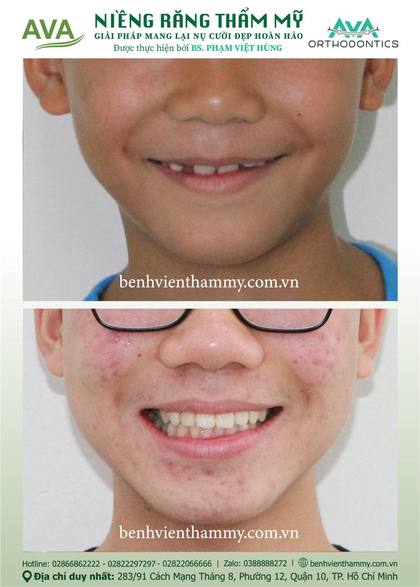 Hình ảnh trước và sau khi niềng răng – niềng răng trả góp quận 10 tại Nha khoa AVA, ca 81