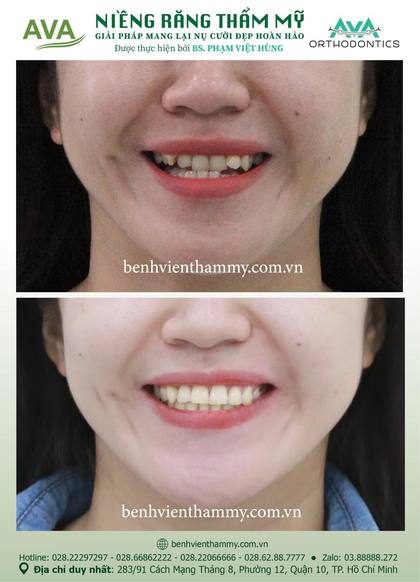 Kết quả niềng răng TPHCM trước và sau tại Nha khoa AVA Quận 10, ca 82