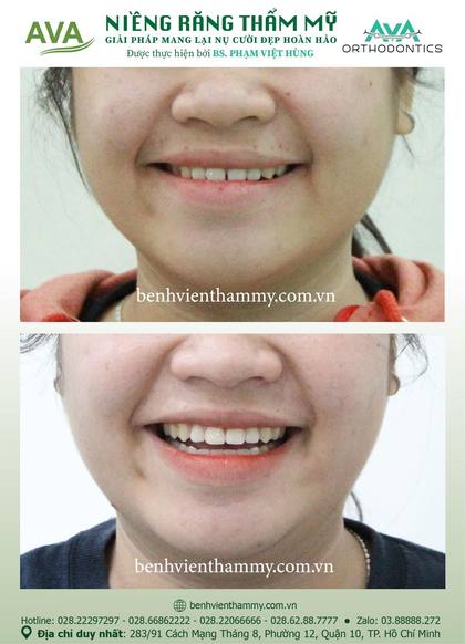 Ca niềng răng trả góp tphcm trước và sau điều trị tại Nha khoa AVA, ca 83