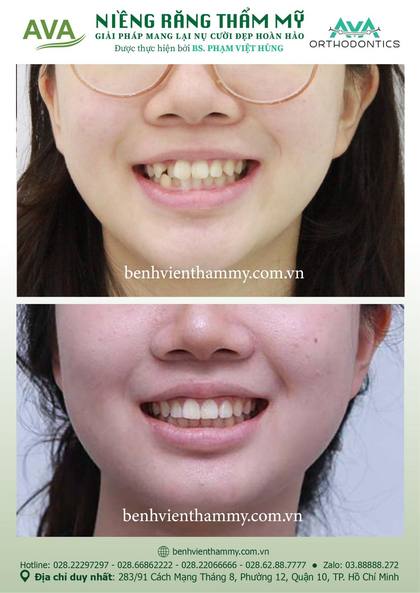 Hình ảnh trước và sau khi niềng răng – niềng răng trả góp quận 10 tại Nha khoa AVA, ca 84