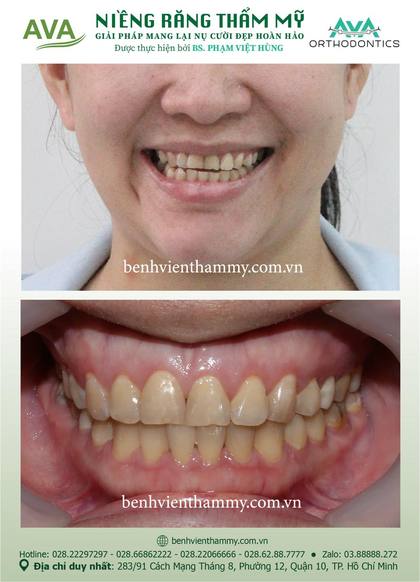 Kết quả niềng răng TPHCM trước và sau tại Nha khoa AVA Quận 10, ca 85