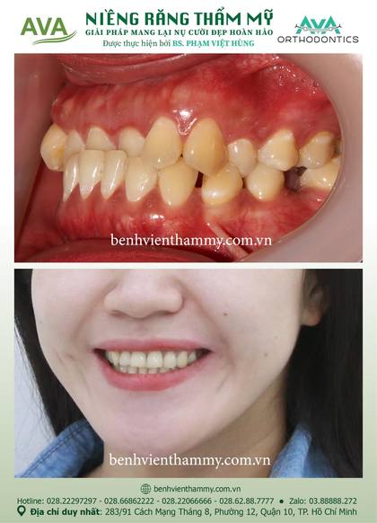 Ca niềng răng trả góp tphcm trước và sau điều trị tại Nha khoa AVA, ca 86