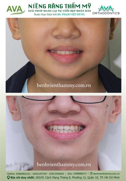 Hình ảnh trước và sau khi niềng răng – niềng răng trả góp quận 10 tại Nha khoa AVA, ca 87