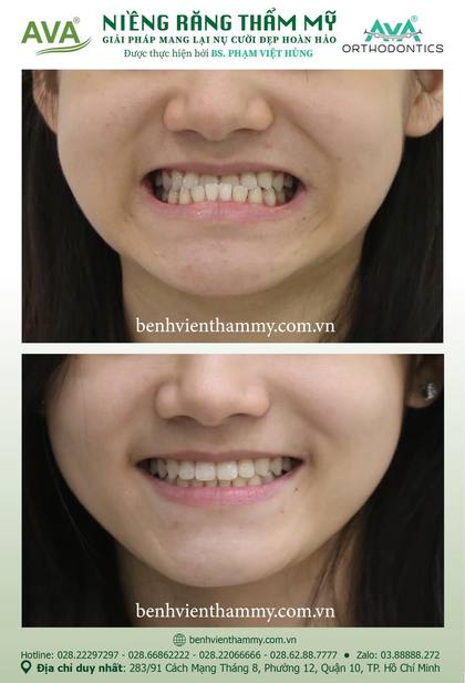 Kết quả niềng răng TPHCM trước và sau tại Nha khoa AVA Quận 10, ca 88