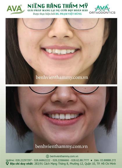 Ca niềng răng trả góp tphcm trước và sau điều trị tại Nha khoa AVA, ca 89