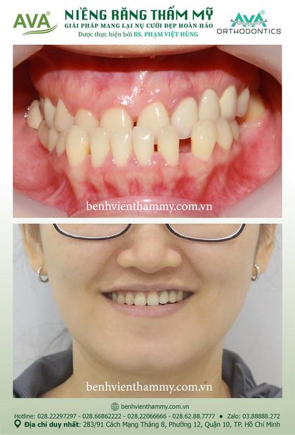 Hình ảnh trước và sau khi niềng răng – niềng răng trả góp quận 10 tại Nha khoa AVA, ca 90