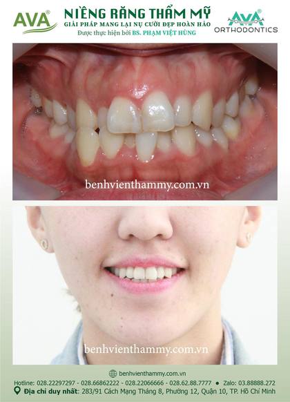 Kết quả niềng răng TPHCM trước và sau tại Nha khoa AVA Quận 10, ca 91