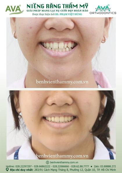 Ca niềng răng trả góp tphcm trước và sau điều trị tại Nha khoa AVA, ca 92