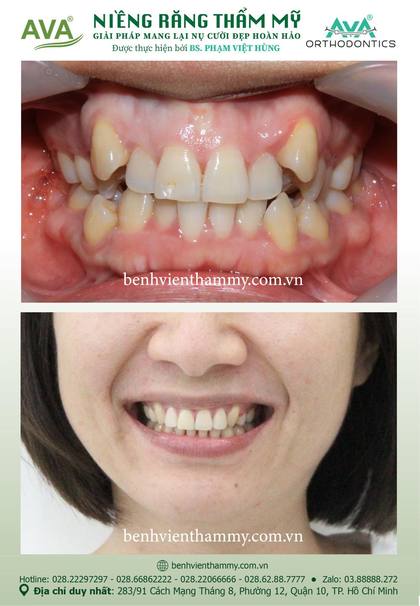 Hình ảnh trước và sau khi niềng răng – niềng răng trả góp quận 10 tại Nha khoa AVA, ca 93