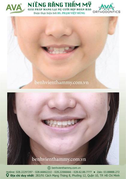 Kết quả niềng răng TPHCM trước và sau tại Nha khoa AVA Quận 10, ca 94