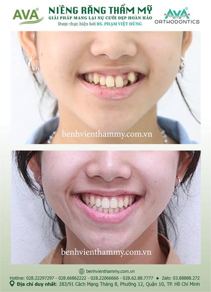 Ca niềng răng trả góp tphcm trước và sau điều trị tại Nha khoa AVA, ca 95