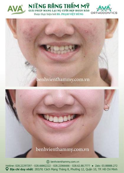 Hình ảnh trước và sau khi niềng răng – niềng răng trả góp quận 10 tại Nha khoa AVA, ca 96