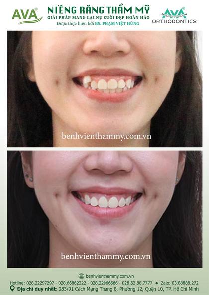 Kết quả niềng răng TPHCM trước và sau tại Nha khoa AVA Quận 10, ca 97
