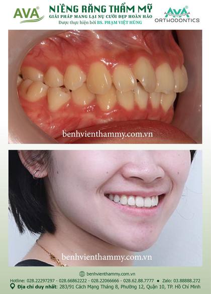 Ca niềng răng trả góp tphcm trước và sau điều trị tại Nha khoa AVA, ca 98
