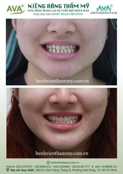 Hình ảnh trước và sau khi niềng răng – niềng răng trả góp quận 10 tại Nha khoa AVA, ca 99